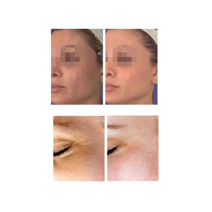 Micro Dermabrasion - Image 2